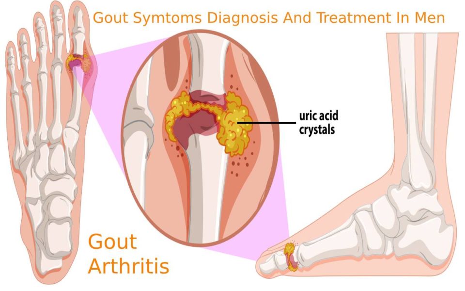 Human Gout arthritis