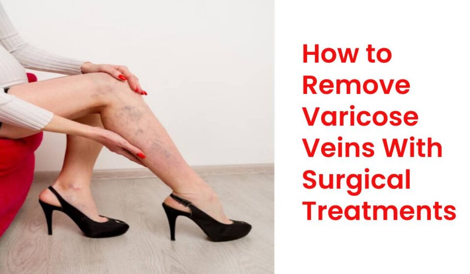 Remove varicose veins